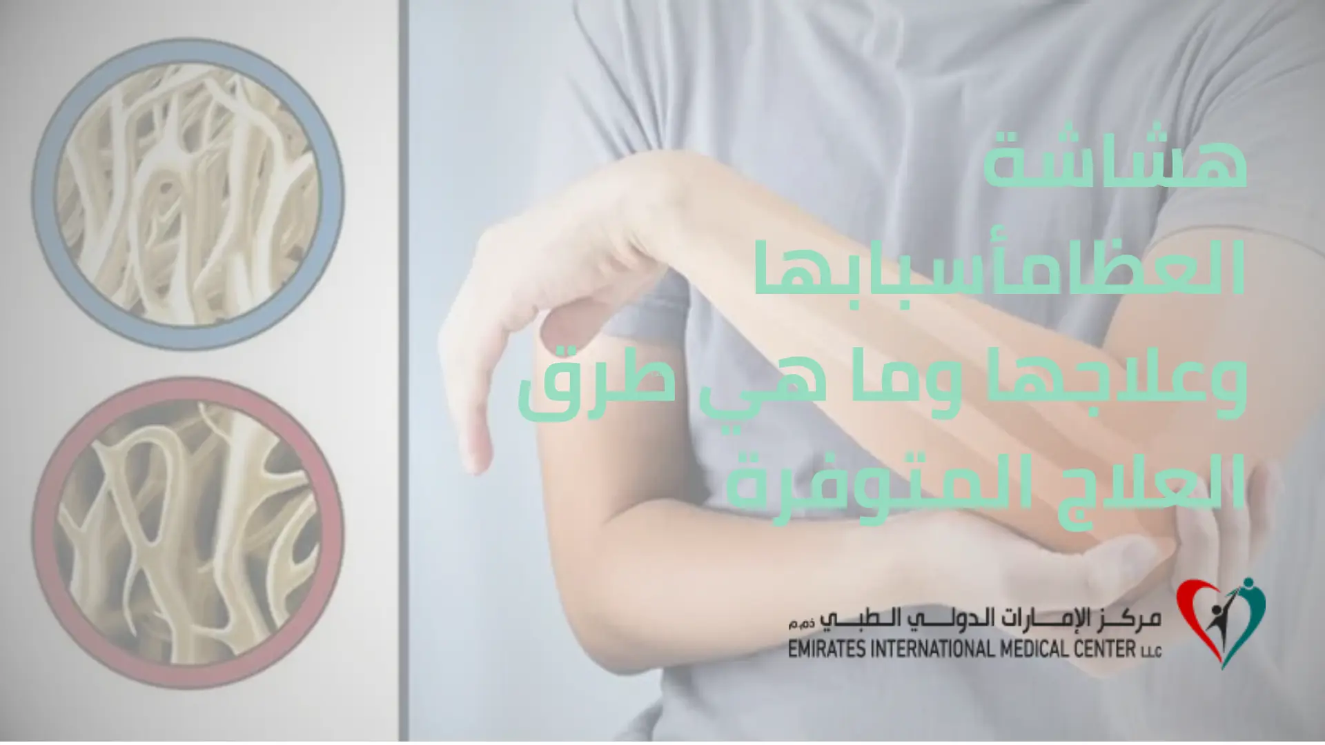 صورة توعوية توضح الفرق بين العظم السليم والعظم المصاب في مقال هشاشة العظام أسبابها وعلاجها من مركز الإمارات الدولي الطبي