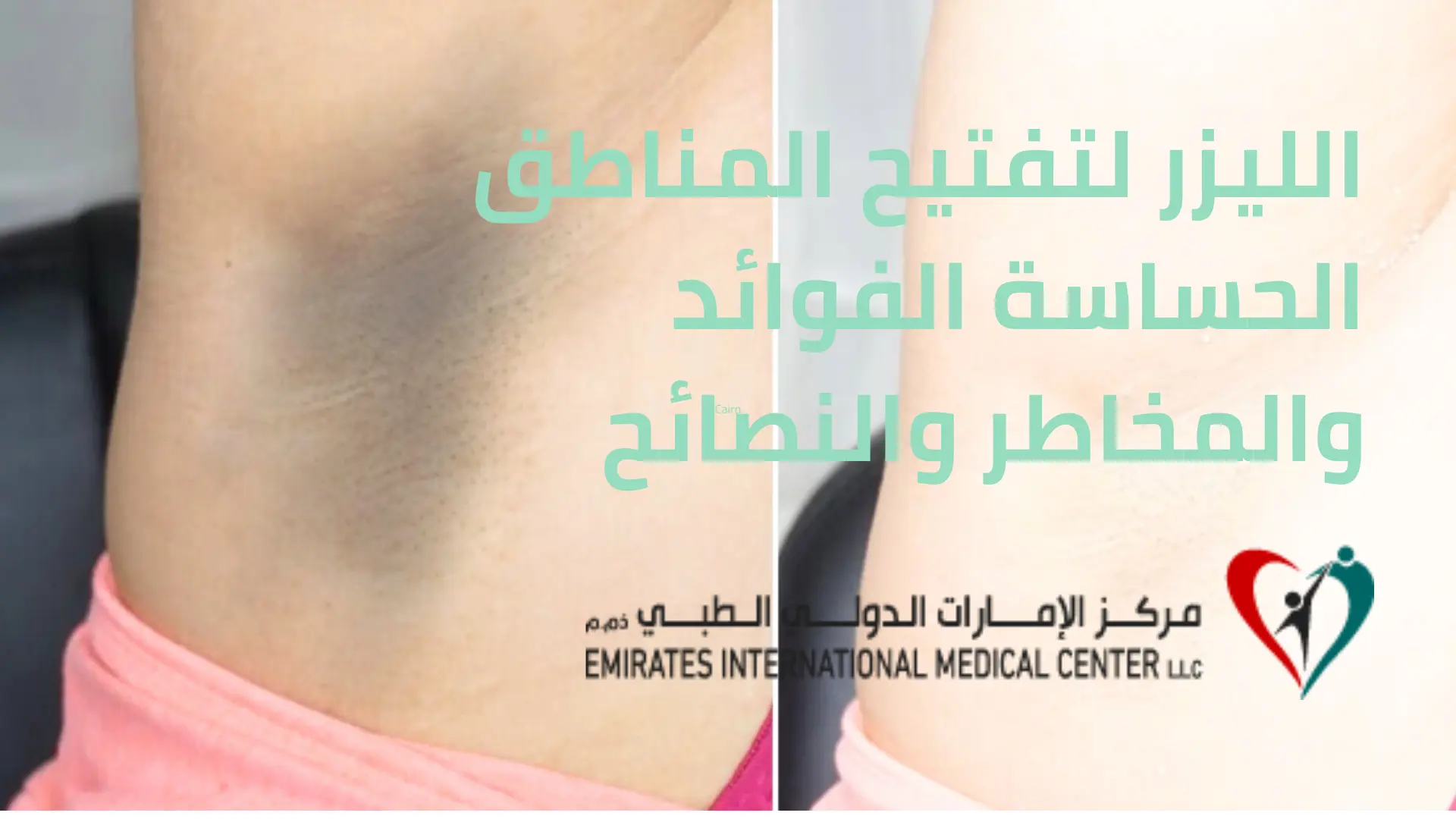 الليزر لتفتيح المناطق الحساسة الفوائد والمخاطر والنصائح قبل وبعد الجلسات