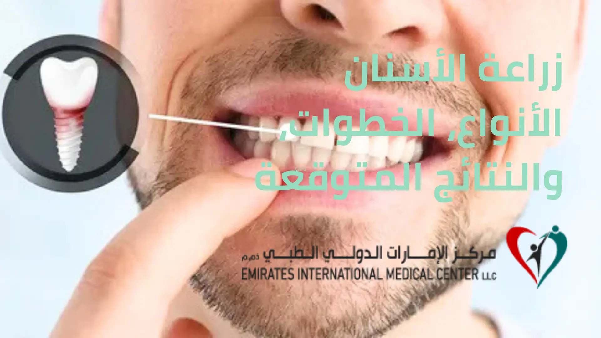 زراعة الأسنان الأنواع، الخطوات، والنتائج المتوقعة