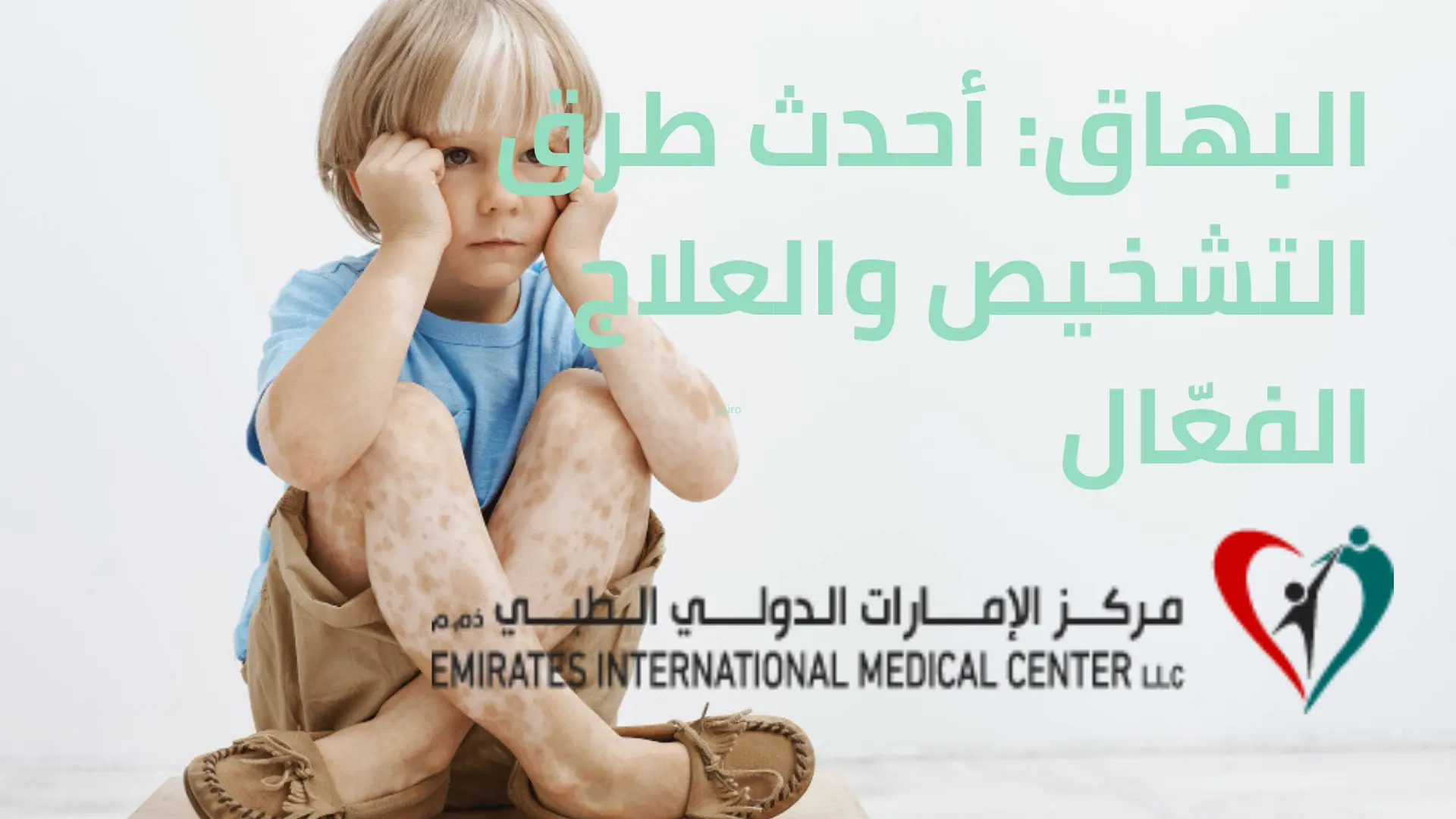 البهاق أحدث طرق التشخيص والعلاج الفعّال | مركز الامارات الدولي الطبي | الشارقة