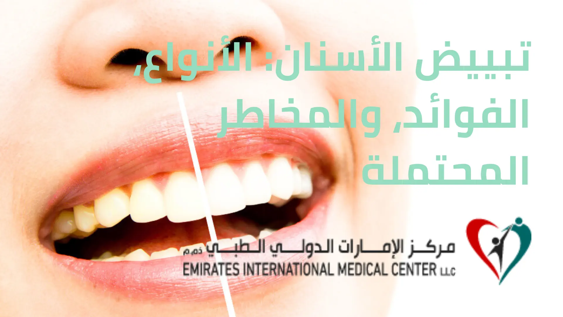تبييض الأسنان الأنواع، الفوائد، والمخاطر المحتملة