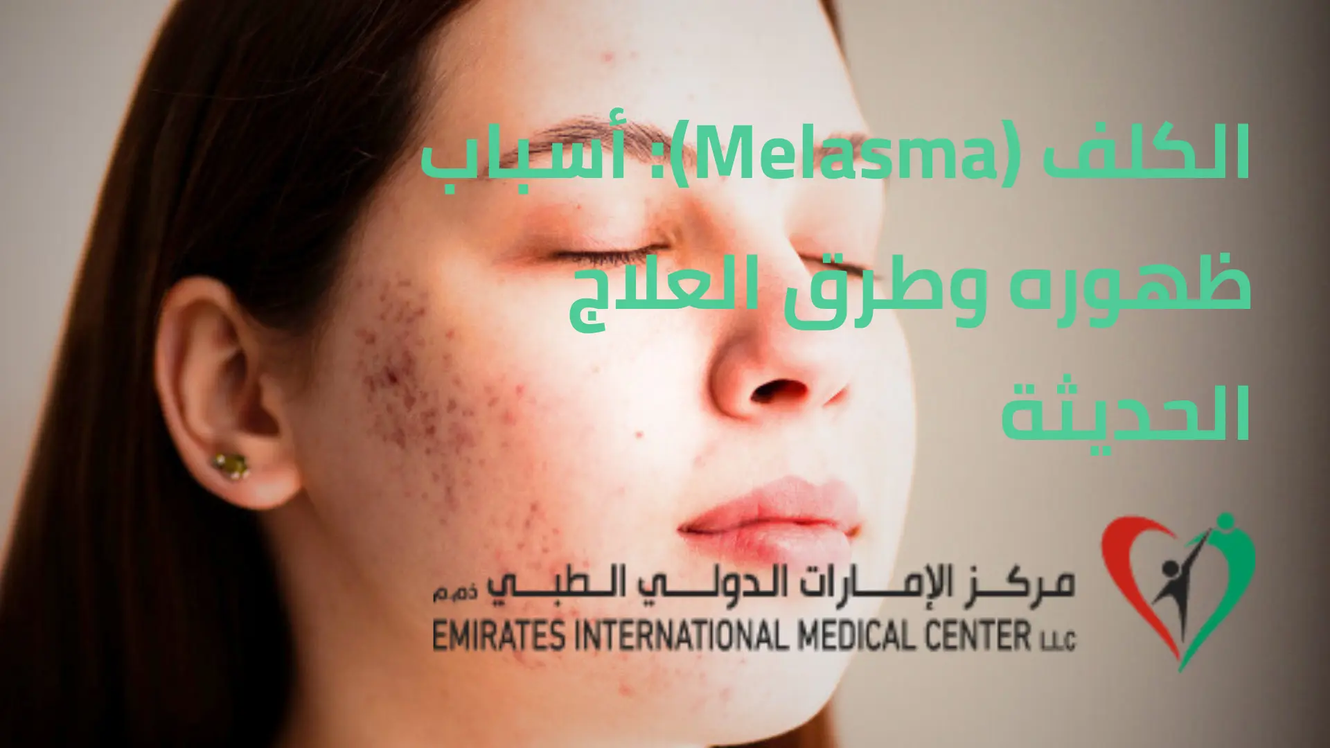 الكلف (Melasma): أسباب ظهوره وطرق العلاج الحديثة