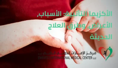 الأكزيما التأتبية | مركز الامارات الدولي الطبي