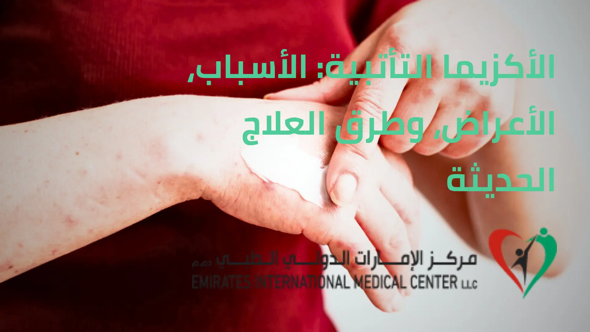 الأكزيما التأتبية | مركز الامارات الدولي الطبي