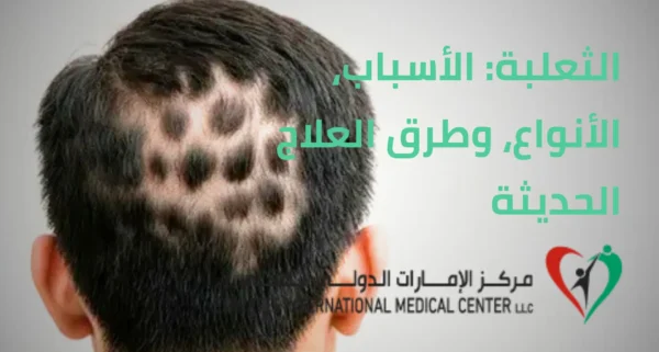 الثعلبة وافضل العلاج الحديث في مركز الامارات الدولي الطبي