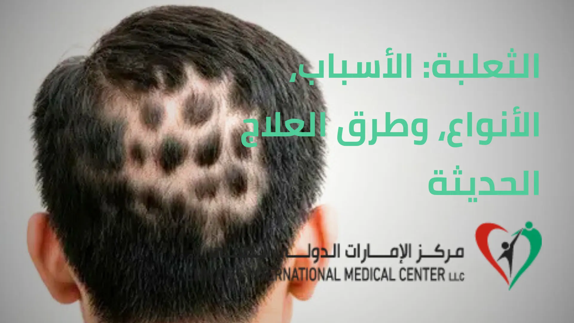 الثعلبة وافضل العلاج الحديث في مركز الامارات الدولي الطبي